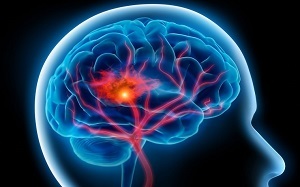 Tracking Seizures: Brain Research Aims to Improve Epilepsy Treatment Tracking Seizures: Brain Research Aims to Improve Epilepsy Treatment Tracking Seizures: Brain Research Aims to Improve Epilepsy Treatment Tracking Seizures: Brain Research Aims to Improve Epilepsy Treatment