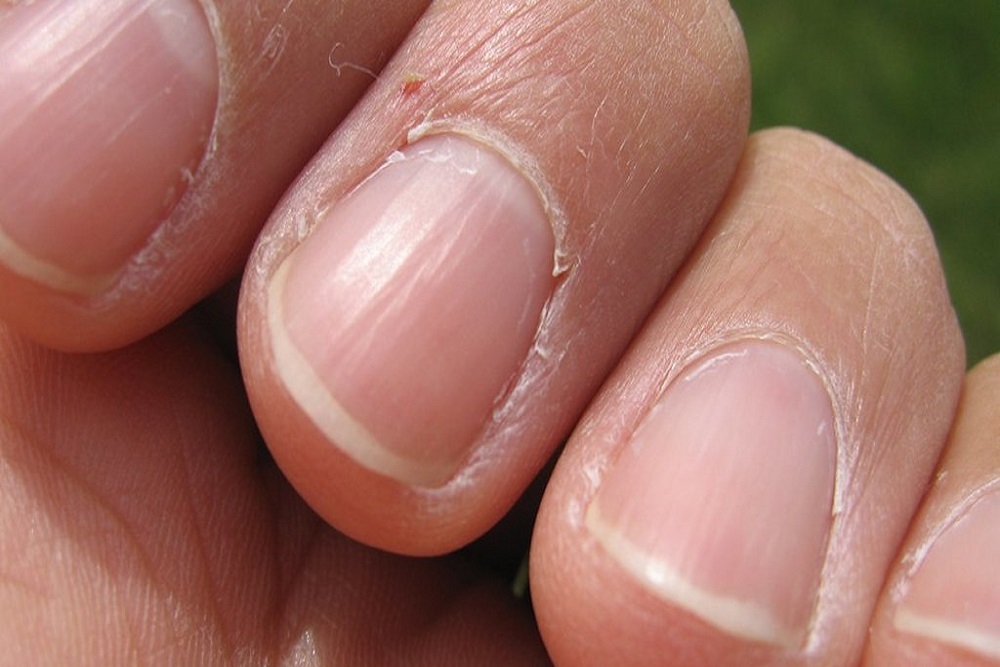 Those Beau’s lines on your nails are telling you something Those Beau’s lines on your nails are telling you something