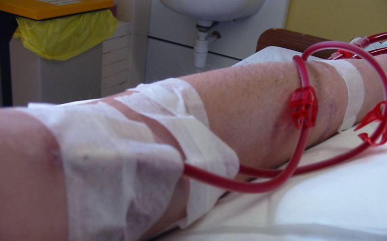There are currently more than 100,000 Brazilians on dialysis. There are currently more than 100,000 Brazilians on dialysis.