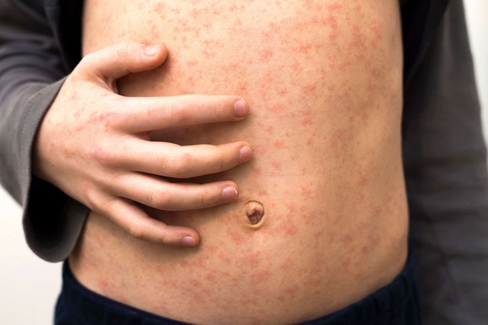 What you need to know about the Ohio measles outbreak
