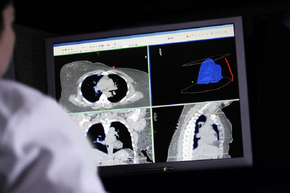 New CMS Lung Cancer Screening Guidelines Can Help Save Lives
