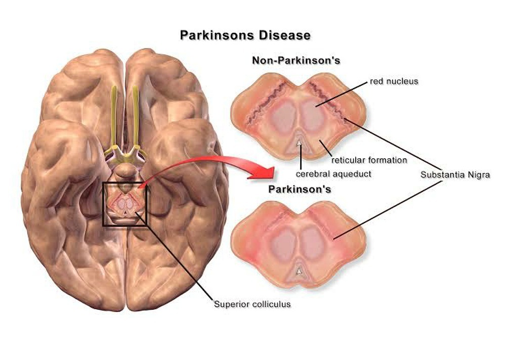 BROOME COUNTY: Living With Parkinson’s Disease: Tips For Caregivers And Their Loved Ones