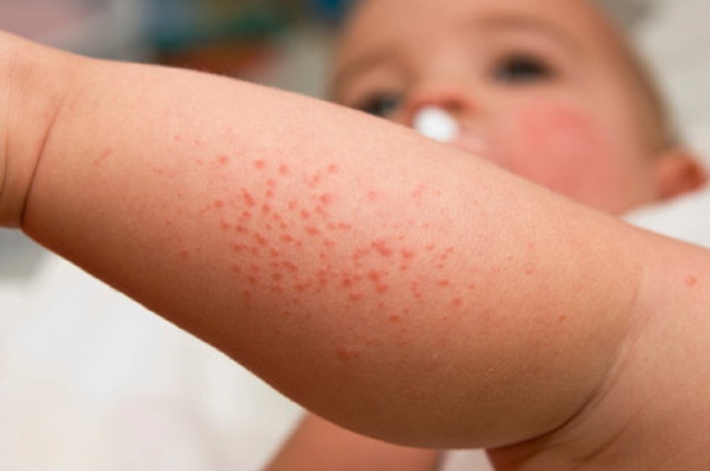 Food Allergy Testing Food Allergy Testing