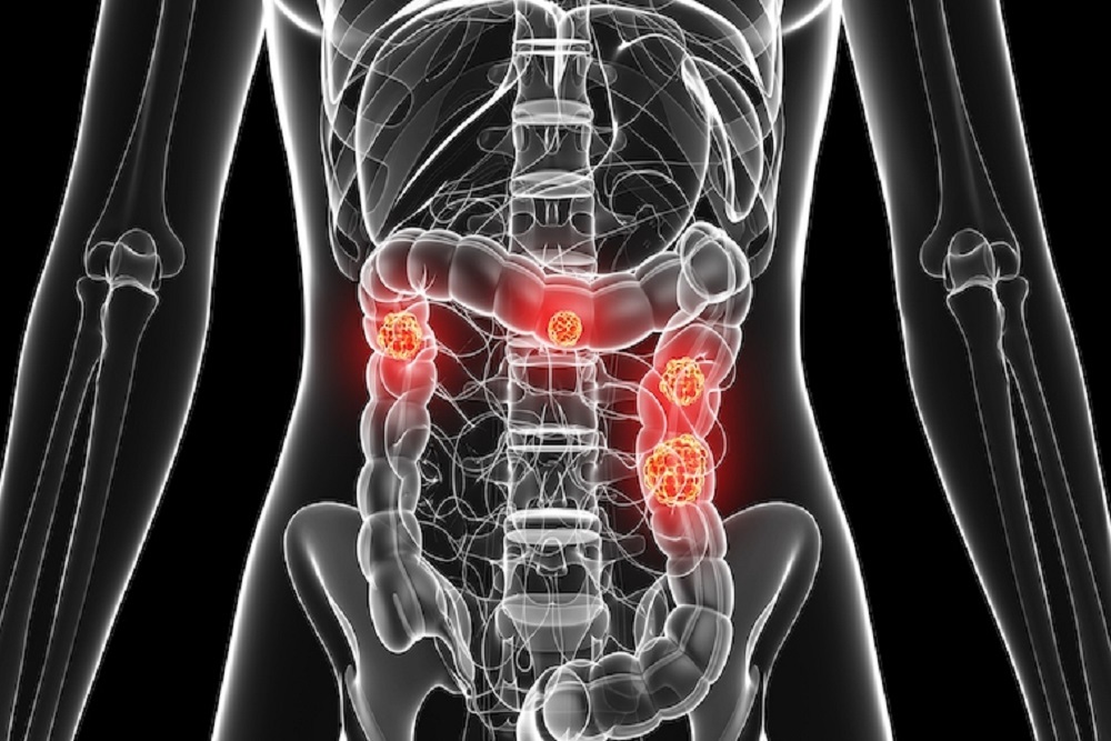 Colorectal Cancer Screening Lagging Among Rural Women